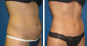 Before & After Photos
